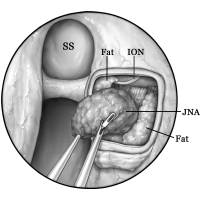 Endoscopic-JNA-Excision-teratment