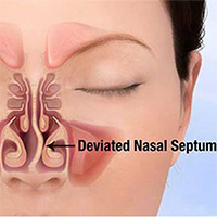 deviated-nasal